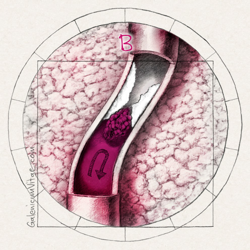Ischaemic stroke y sus causas