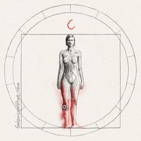 Varices y sus causas